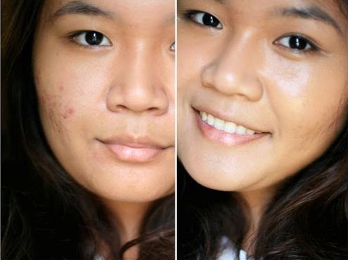 Cach tri mun cam triet de hieu qua den 99 26