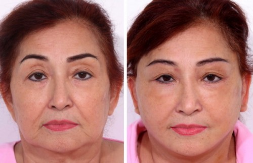 Cang da mat e1479893718314